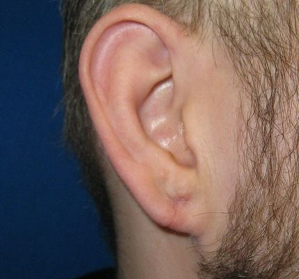 gauge earlobe repair connecticut jandali plastic surgery