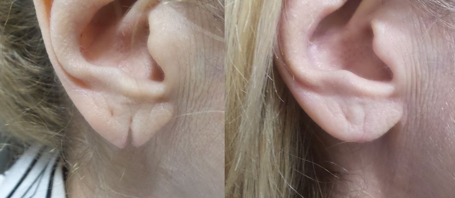 Split Torn Stretched Earlobe Repair Connecticut