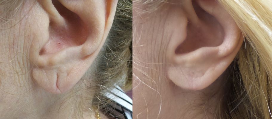 Split Torn Stretched Earlobe Repair Connecticut