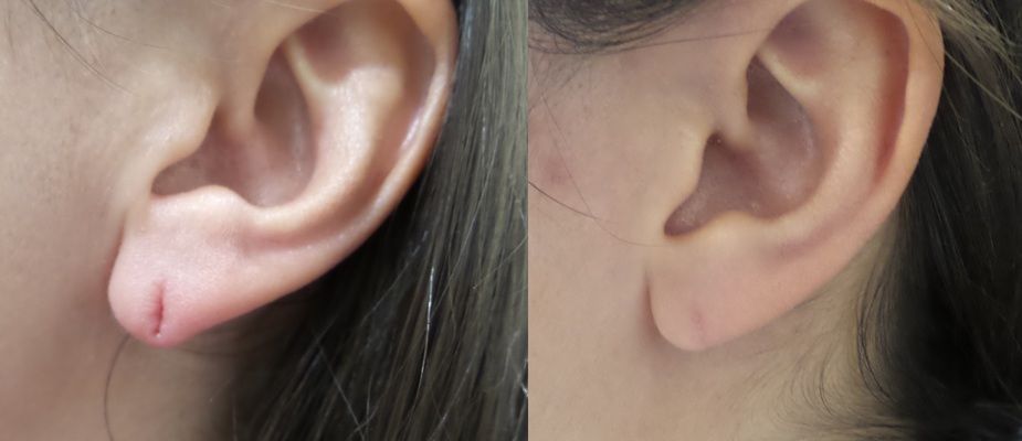 Split Torn Stretched Earlobe Repair Connecticut