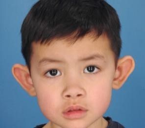 Child with an ear deformity