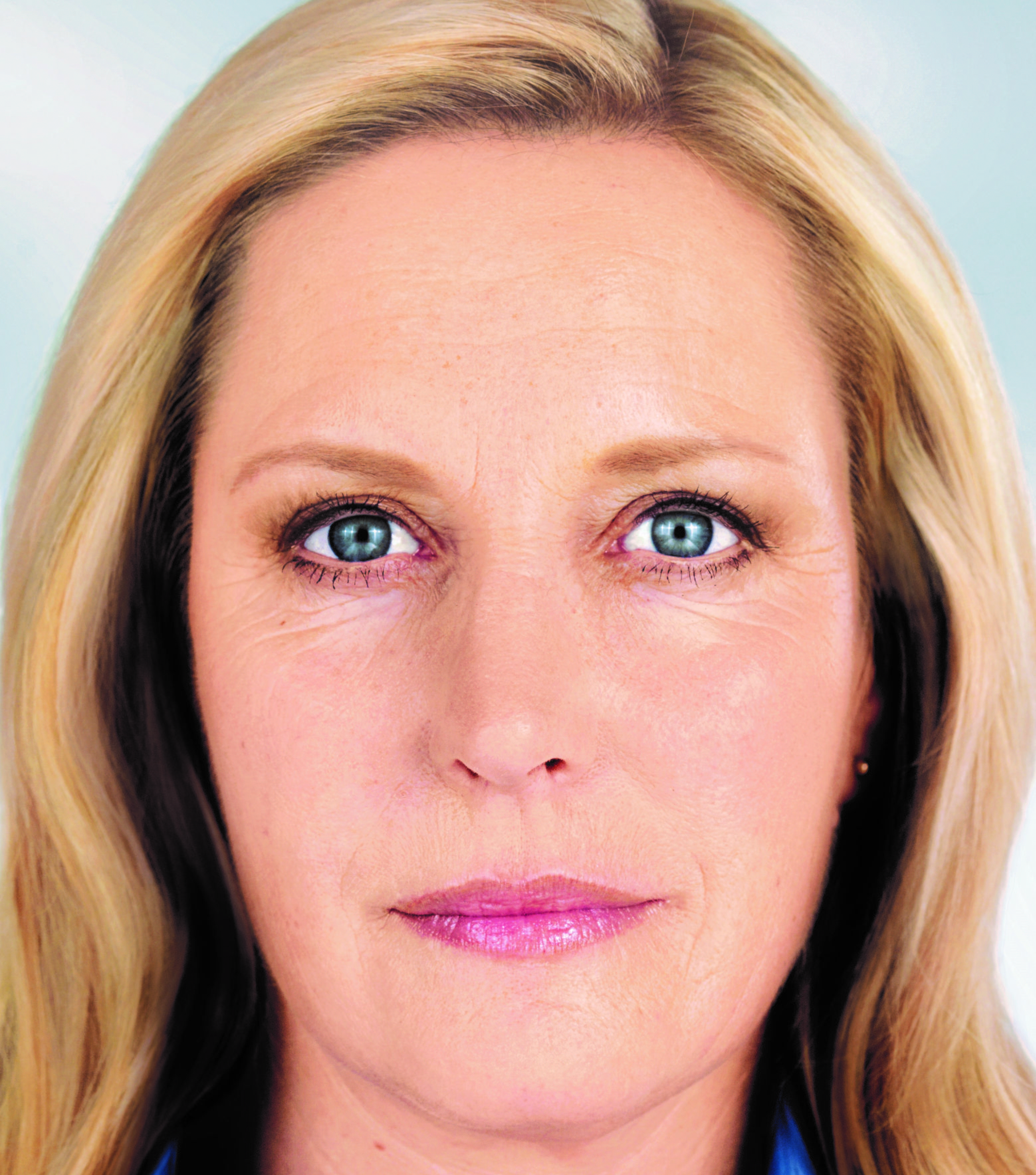 Sculptra before and after photo