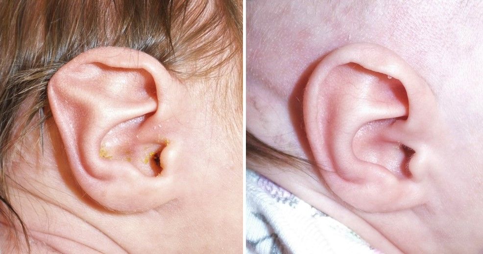 Stahls ear deformity correction