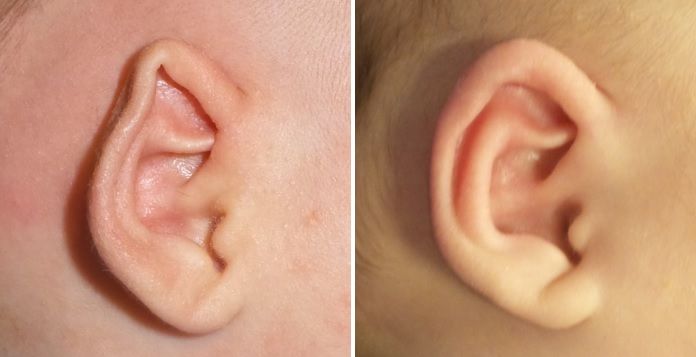 pointed baby ear