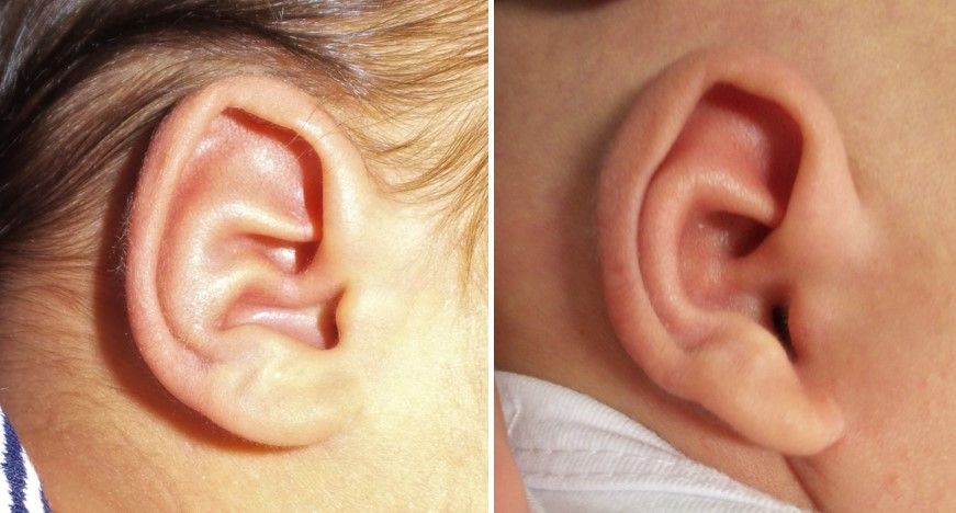 conchal crus ear deformity correction