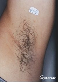 Laser Hair Removal Underarms - Jandali Plastic Surgery - Connecticut
