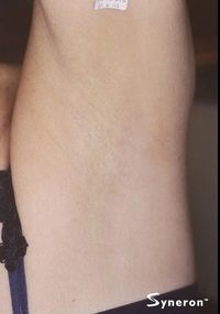 Laser Hair Removal Underarms - Jandali Plastic Surgery - Connecticut