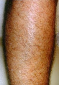Laser Hair Removal Legs - Jandali Plastic Surgery - Connecticut