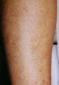 Laser Hair Removal Legs - Jandali Plastic Surgery - Connecticut