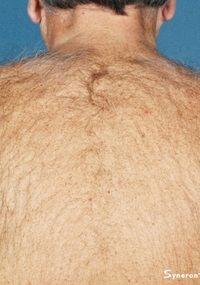 Laser Back Hair Removal - Jandali Plastic Surgery - Connecticut