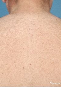 Laser Back Hair Removal - Jandali Plastic Surgery - Connecticut