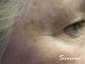 IPL brown sun spot laser removal - Jandali Plastic Surgery - Connecticut