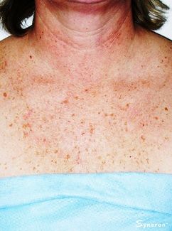 IPL chest and neck sun damage laser removal - Jandali Plastic Surgery - Connecticut