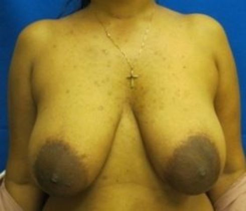 Area reduction before