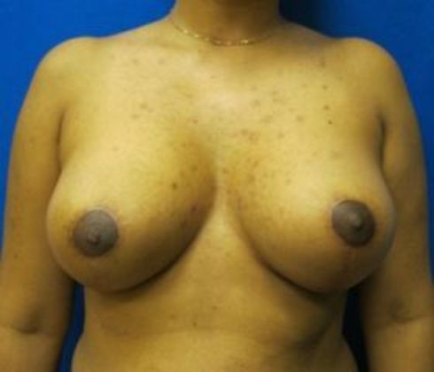 Area reduction after